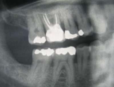 Foyers infectieux dentaires et leurs complications