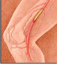 arteriopathies-iatrogenes-toxiques