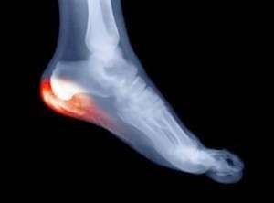Diagnostic d’une douleur du pied