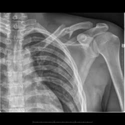 Fracture claviculaire