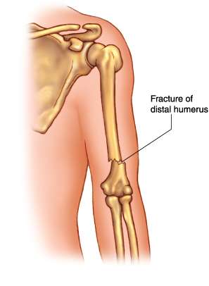 Fractures de l'extrémité supérieur de l'humérus