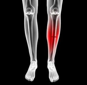Fracture de jambe