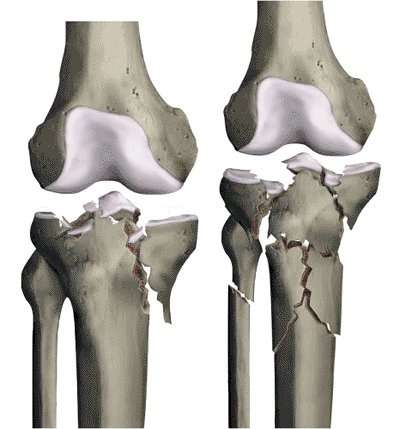 Fractures des plateaux tibiaux : fractures récentes