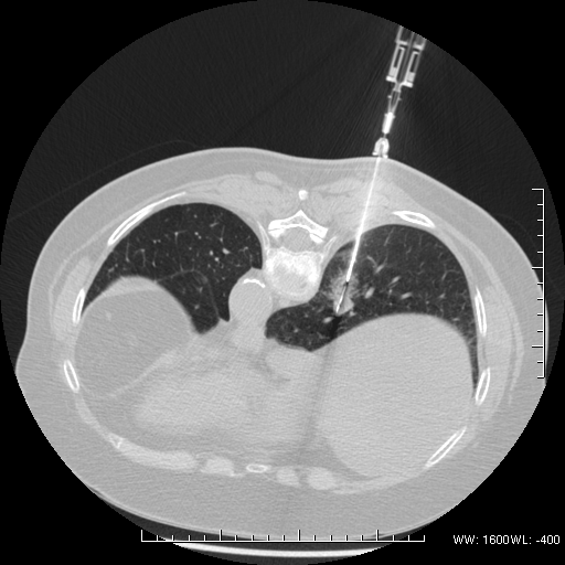 Apport de la biopsie pulmonaire transthoracique dans le diagnostic de pneumonie organisée