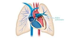 Hypertension artérielle pulmonaire