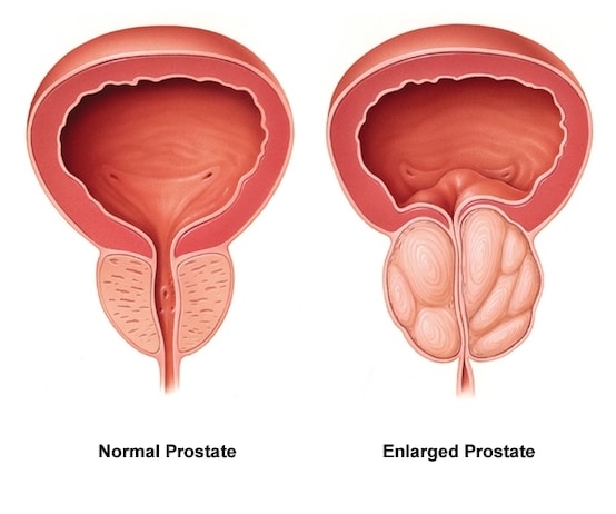 problema prostatitei în tratamentul prostatitei anapa