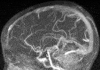 Angiographie cérébrale normale (Suite)