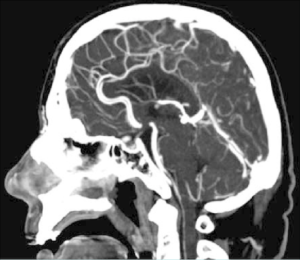 Angiographie cérébrale normale