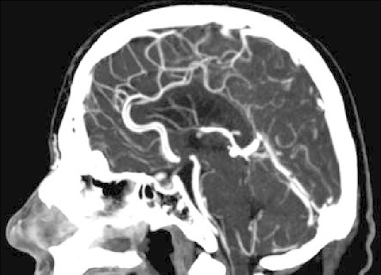 Angiographie cérébrale normale