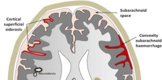 Angiopathies amyloïdes cérébrales