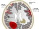 Angiopathies amyloïdes cérébrales