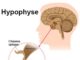 Aspects neurochirurgicaux des adénomes hypophysaires (Suite)