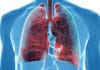 Cancer broncho-pulmonaire (cancer bronchique)
