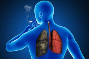 Techniques et indications chirurgicales dans le cancer bronchique