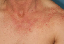 Dermatite allergique de contact (Suite)
