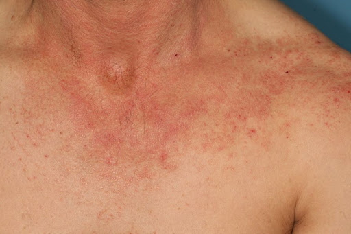 Dermatite allergique de contact (Suite)