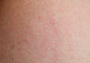 Dermatite allergique de contact