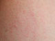Dermatite allergique de contact
