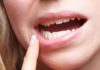 Ulcération ou érosion des muqueuses orale et génitale