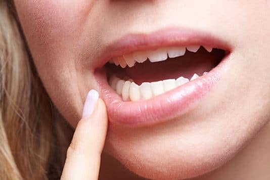 Ulcération ou érosion des muqueuses orale et génitale