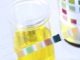 Examen cyto-bactériologique des urines "ECBU"