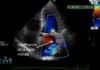 Échocardiographie et échographie cardiaque