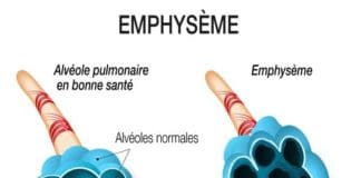Emphysème pulmonaire Grands syndromes anatomocliniques (Suite)