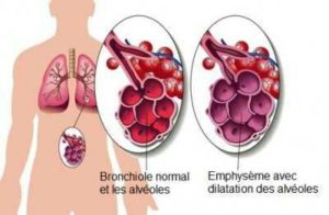 Emphysème pulmonaire Grands syndromes anatomocliniques