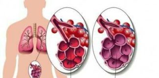 Emphysème pulmonaire Grands syndromes anatomocliniques