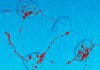 Maladies à prion ou encéphalopathies spongiformes transmissibles (Suite)