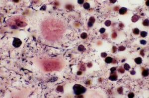 Maladies à prion ou encéphalopathies spongiformes transmissibles