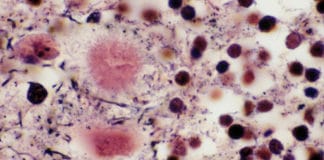 Maladies à prion ou encéphalopathies spongiformes transmissibles