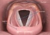 Anatomie descriptive, endoscopique et radiologique du larynx (Suite)