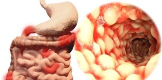 Hémorragie digestive