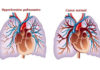 Hypertension artérielle pulmonaire primitive