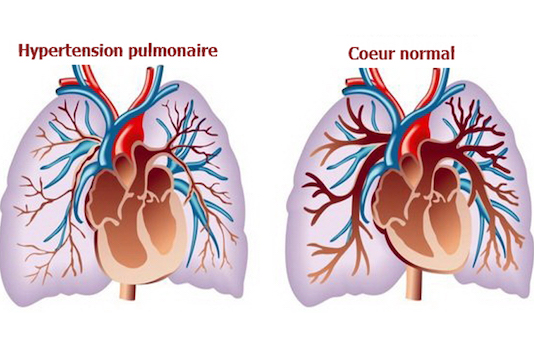 Hypertension artérielle pulmonaire primitive