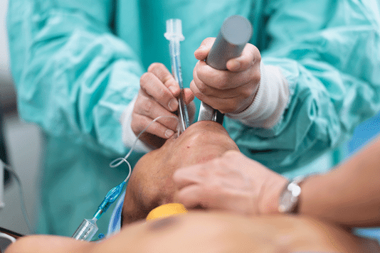 Intubation : technique, indication, surveillance, complications