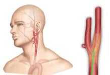Lésions athéromateuses des artères extra- et intracrâniennes