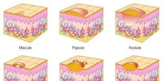 Lésions élémentaires de la peau : sémiologie cutanée