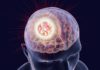 Manifestations psychiatriques des tumeurs cérébrales : approche clinique et thérapeutique
