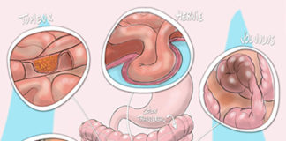 Occlusion intestinale du côlon