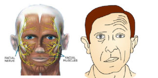 Paralysies faciales (Suite)