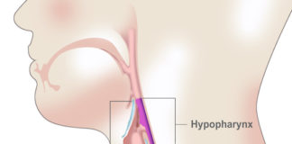 Cancer de l'hypopharynx