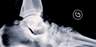 Ostéoarthropathies nerveuses