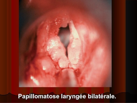 papillomavirus larynge)