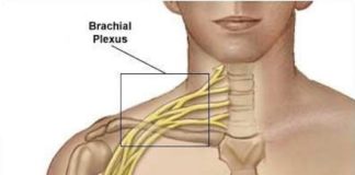 Paralysie obstétricale du plexus brachial