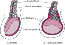 Torsion du cordon spermatique