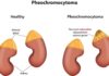 Phéochromocytome