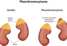 Phéochromocytome