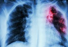 Tuberculose pulmonaire et primo-infection tuberculeuse